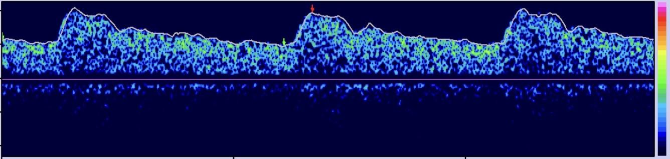 Transcranial Doppler ultrasound equipment used in VBM Lab cerebrovascular research